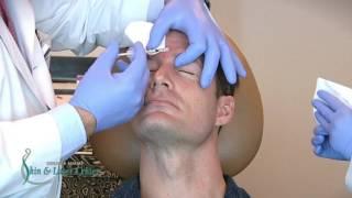 BroTox Treatment by Dr. Marty Zaiac