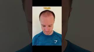 12 months #hairtransplant update #transplantecapilar #hairtransplantcolombia #bogotahairlines