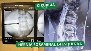 Endoscopia da coluna por acesso transforaminal trata de hérnia  de disco lombar 10.12.24