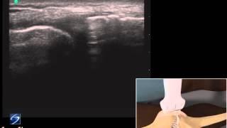 How To: Ultrasound Exam of the Medial Collateral Ligament 3D Video