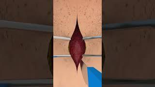 How Tracheotomy Tube Work #short #ytshorts  - creativelearning3d