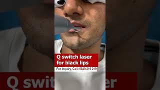 Q switch laser for black lips #shorts  #q_switch_laser #Q_switch_laser_black_lips #skinaaclinic