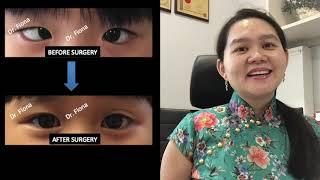 Squint Surgery  Pembedahan Juling     斜视手术