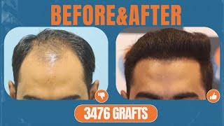 Transformed: Witness the Natural Results of a 3476 Graft Hair Transplant at Alloroots