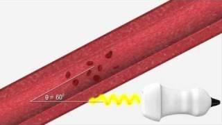 Ultrasound Physics - Explaining Doppler