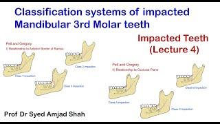 Classification system of Impacted Mandibular 3rd Molar | Pell & Gregory | Syed Amjad Shah