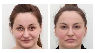 The results of dermal fillers: before and after