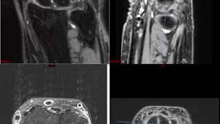 Wrist MRI (Approach to MSK MRI Series)