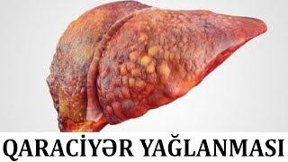 Qaraciyər yağlanması zamanı BUNLARA diqqət edin!