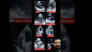 Some important Echo #echocardiography #doctor #youtubeshorts #youtube #trendingshorts #viralshorts