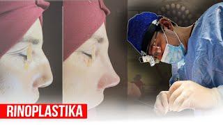 Rinoplastika