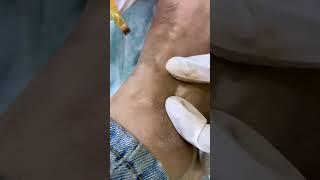 Micropigmentation for Vitiligo | vitiligo skin disease treatment | Skinaa Clinic #shorts #viral