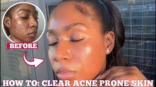 HOW I CLEARED MY ACNE SCARS & HYPERPIGMENTATION *FOR GOOD* IN ONE MONTH | 3 STEPS FOR FLAWLESS SKIN