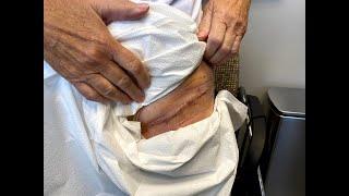 1 Week Follow Up Cosmetic Hip Replacement Doing Great | Dr. Robert Cagle