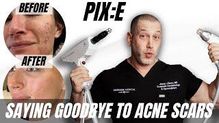 PIX:E BY ROHRER WITH EMER SKIN TRANSFORMED MY ACNE SKIN AND BOOSTED CONFIDENCE | Dr. Jason Emer