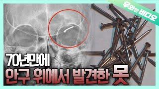 0.000000001%의 확률! 머릿속에서 발견된 못┃Found a NAIL In One's Head...!