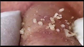 Relaxing With Top Skin #058 blackheads on nose compilation