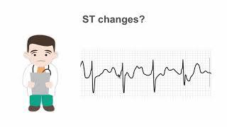 Recognizing ST segment changes on the stress ECG (EKG)