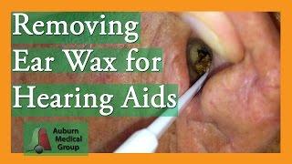 Removing Ear Wax for Hearing Aids #earwaxremoval | Auburn Medical Group