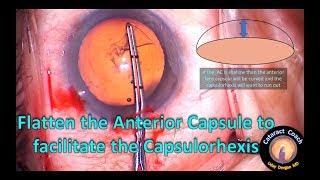 Flatten the anterior lens capsule to facilitate capsulorhexis creation in cataract surgery