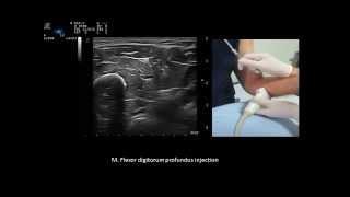 Ultrasound guided upper limb  botulinum toxin injections,  by Murat Karkucak MD