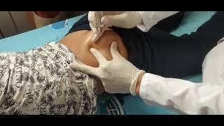 intramuscular injection into the gluteal muscle #doctor #intramuscularinjection #injection