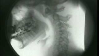 Broken Neck After A Car Crash | Digital Motion X-Ray | MRI