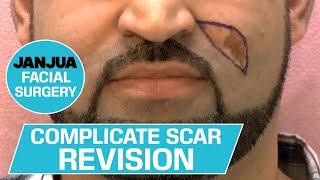 COMPLICATED SCAR REVISION: LEFT CHEEK - DR. TANVEER JANJUA - NEW JERSEY