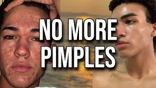 NEVER Get Another Pimple AGAIN