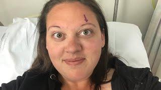 My cancer journey, my biopsy on my eye up until it was removed