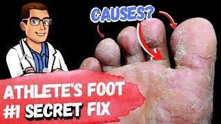BEST Athlete's Foot Fungus Treatments [HOME Remedies + 3 BIG SECRETS]