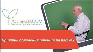 Причины появления трещин на пятках возраст, диабет, беременность, лишний вес, педикюр, инфекция