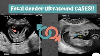 It's baby boys Day : Gender Compilations @ various weeks: Ultrasound cases