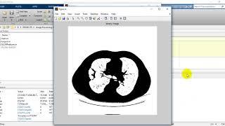 Lung Cancer Detection and Classification Using Matlab source code