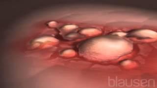 Eczema Animation