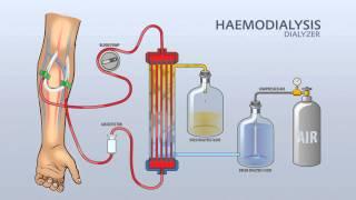 HAEMODIALYSIS DIALYZER