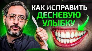 3 способа исправить десневую улыбку. Когда можно обойтись без операции?