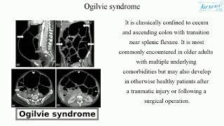 Ogilvie syndrome