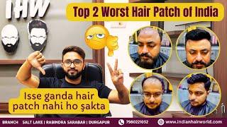 Top 2 Worst Hair Patches in India: Isse Ganda Hair Patch Nahi Ho Sakta - Must Watch!