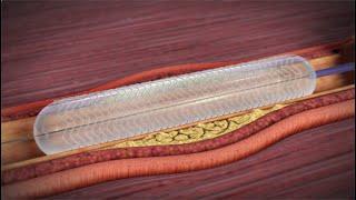 What is a Coronary Angioplasty?