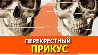 Перекрестный прикус как исправить. От чего меняется прикус. Исправление прикуса, как выровнять зубы