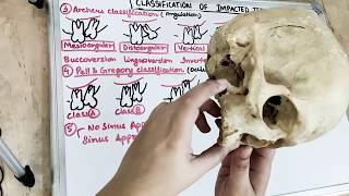 classification of impacted teeth I dental lectures