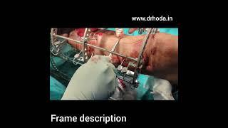 Ilizarov Surgical Technique - Infected Tibia fracture Non union - Dr Shamsul Hoda - Ilizarov Lecture