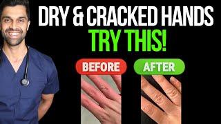 Dry cracked and bleeding hands? Here is one simple trick! | Doctor Azad