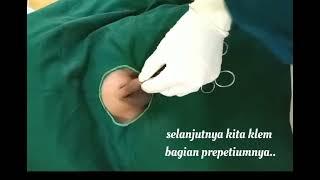 Cara Memotong PREPUTIUM dengan Couter/Laser