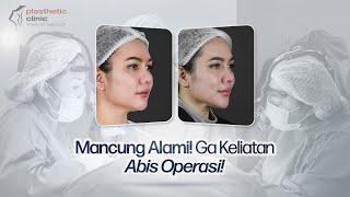 Honest Review Operasi Tip Plasty‼️ II Operasi Hidung di Indonesia 