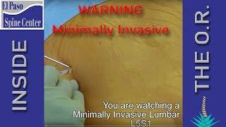 Live Spine Surgery: Minimally Invasive Lumbar Fusion