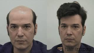 Aplicación prótesis capilar indetectable - Hair Replacement fitting video (Pablo) - Hair Inspira