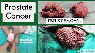 Testis Removal surgery in prostate cancer