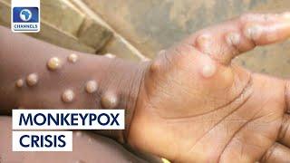 MonkeyPox Crisis: It Can Be Transmitted Through Skin To Skin Contact  - NCDC